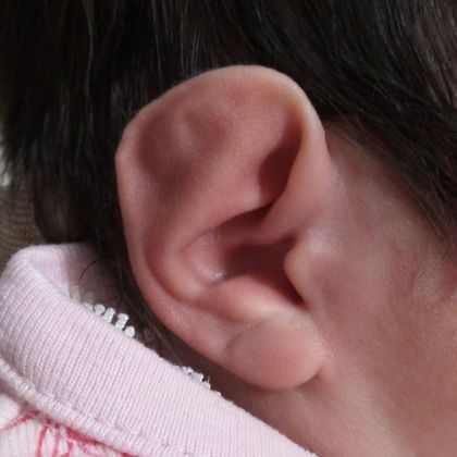 Flat Helix Ear Deformity | Ears R Us